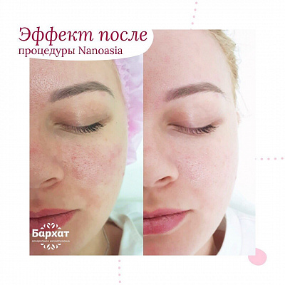 Пилинг лица. Ultra Подарки Ульяновск. Подарочный сертификат на натуральную пилинг лица. Ultra Подарки Ульяновск. 8 800-505-9503. Пилинг лица  #вМоскве#, чистка лица, очищение лица, химический пилинг